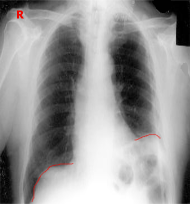 Chest X-ray showing an elevated left hemidiaphragm