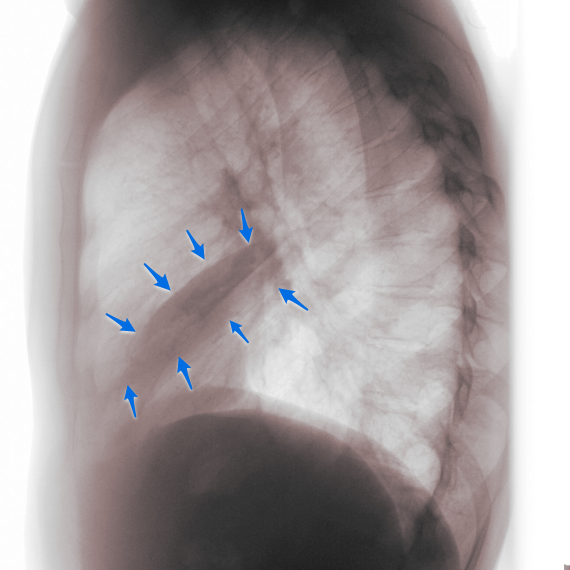 Figure 2 showing a lateral x-ray of a patient with right middle lobe collapse.