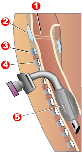 Figure 2 shows placement of a tracheostomy tube. Legends 1= vocal cords, 2 is cricoid cartilage, 3 is first tracheal ring, 4 is second tracheal ring and 5 is a cuffed tracheal tube.