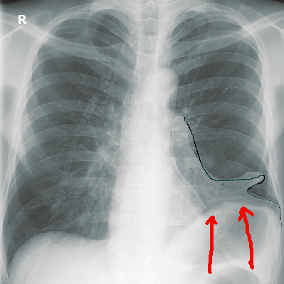 Figure 3 showing an x-ray of a patient with left lower lobe collapse. Note elevation of diaphragm