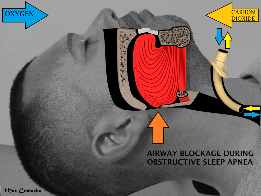 Figure-4-showing-position-of-tracheostomy-tube-in-a-supine-patient.-Image-courtesy-2