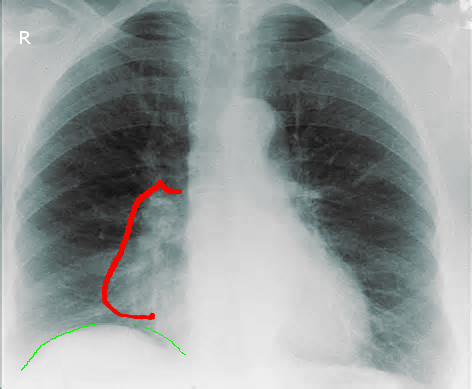 Figure 4 showing right middle lobe collapse in a patient with hilar adenopathy.