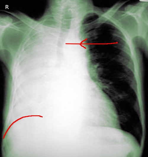 Figure 5 shows complete right lung collapse in a post operative patient. Note trachea has shifted to the side of the collapse.