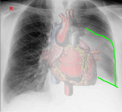 Figure 6 showing left lower lobe collapse in a patient with a bronchial carcinoid. Note elevation of left hemidiaphragm