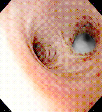 Figure 7 showing carina during bronchoscopy. There is a large mucus plus obstruction the right main bronchus.