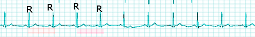 In method 1, shown below. The ECG below shows regular R waves. The successive R waves occur after 5-large squares (which represents one second).