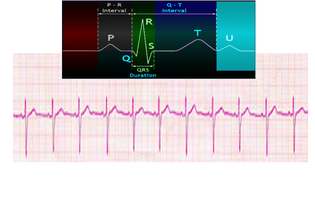 The image above shows a magnified view of the PQRST waveform.